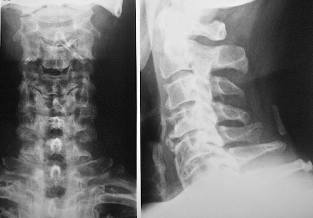 röntgen der halswirbelsäule mit osteochondrose