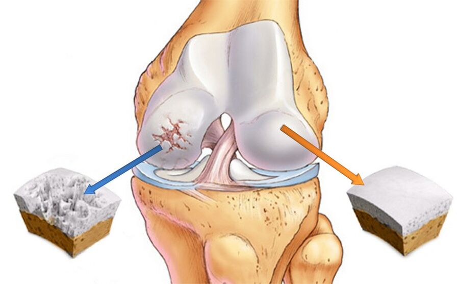 Arthrose des Kniegelenks
