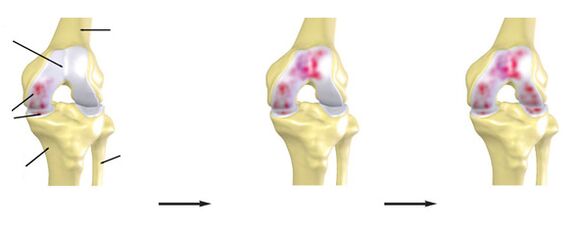 Der Grad der Arthrose des Kniegelenks