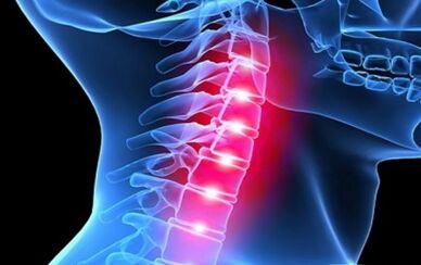 Symptome der Osteochondrose der Halswirbelsäule