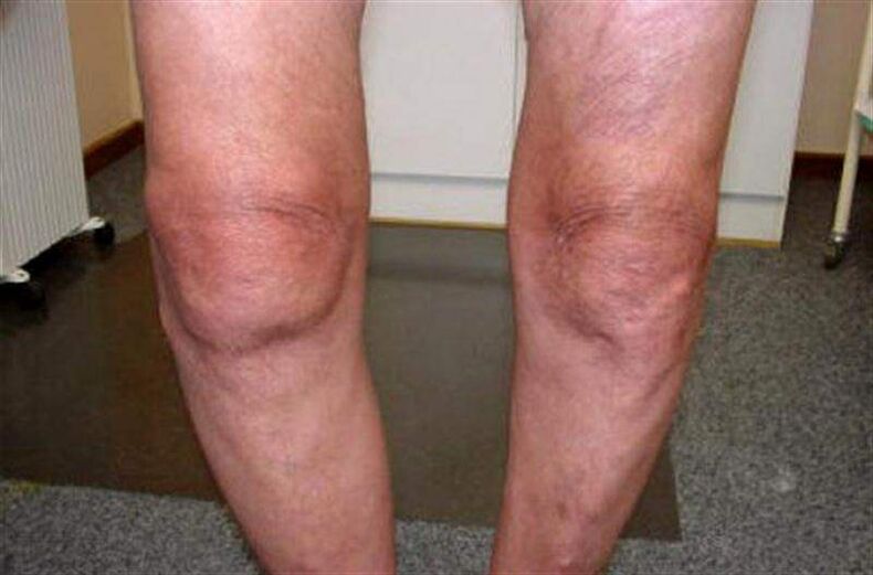 geschwollenes Knie aufgrund von Arthritis
