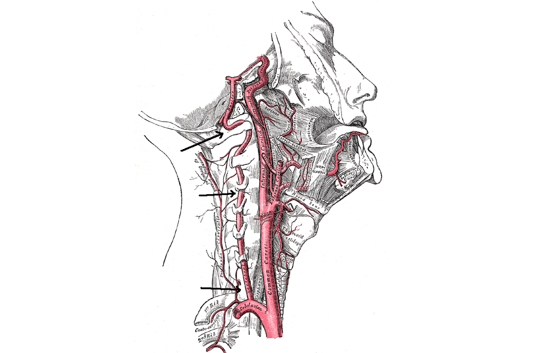 Kompression der Wirbelarterie mit zervikaler Osteochondrose