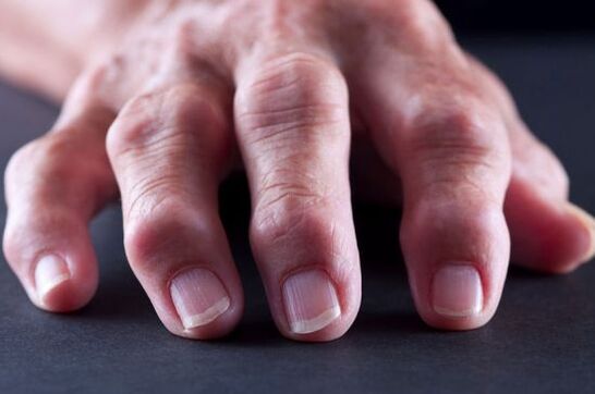 Gelenkdeformationen der Finger aufgrund von Arthrose oder Arthritis